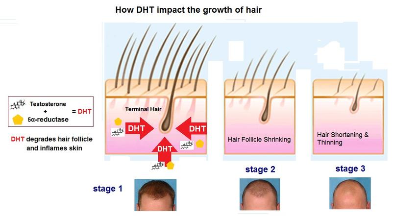 hair loss DHT