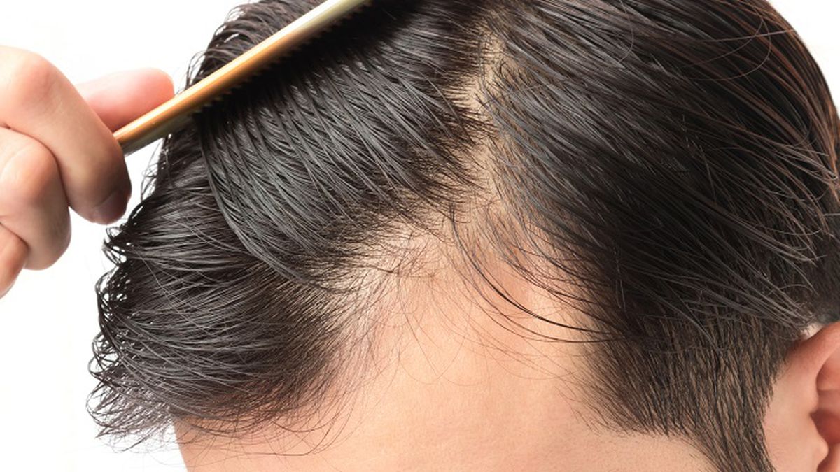 mens hair loss